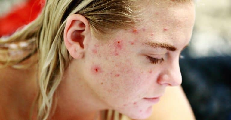 How To Tell If You Have Acne or Rosacea