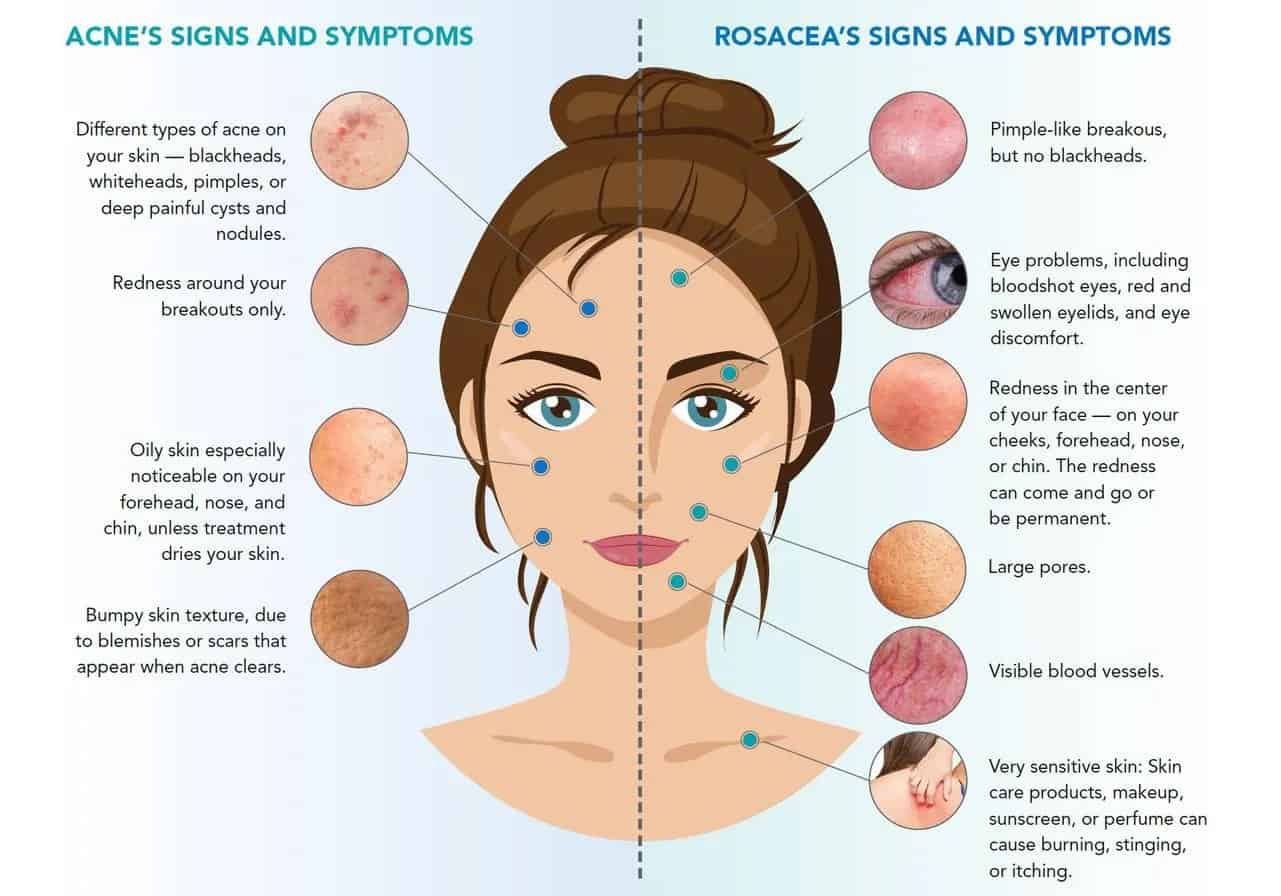 How To Tell If You Have Acne or Rosacea | Good Fun Health